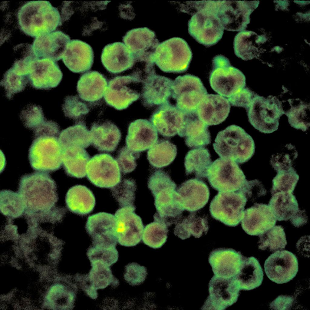 North Carolina Teen Critically Ill After Rare “Brain-Eating Amoeba” Infection